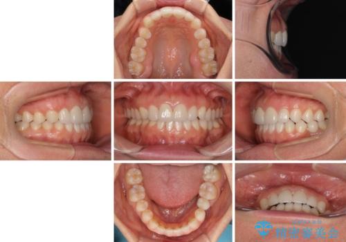 前歯を綺麗にしたい 部分矯正とセラミック治療の治療後