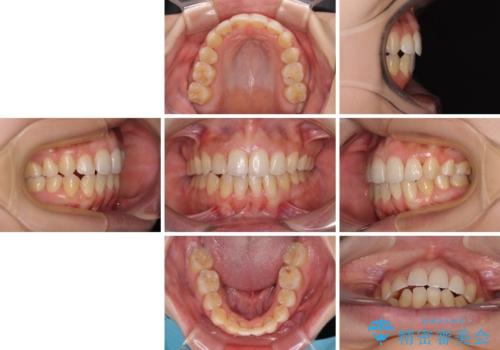 後戻りの再矯正 ワイヤー装置でデコボコと隙間を改善の治療後