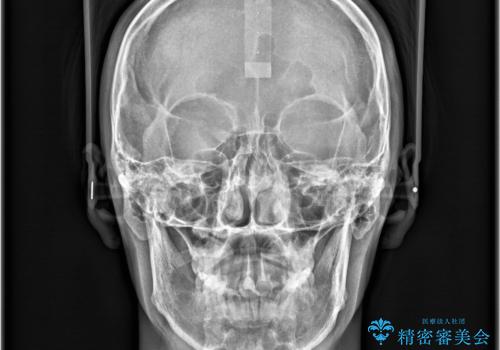 【ワイヤー矯正 11ヵ月で矯正終了!】歯のでこぼこを治したい! の治療後