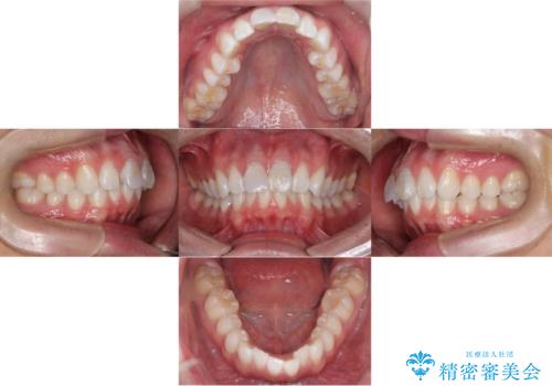【ワイヤー矯正 11ヵ月で矯正終了!】歯のでこぼこを治したい! の治療前