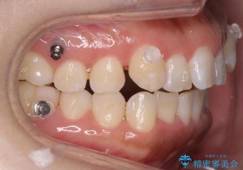 八重歯を非抜歯で マウスピースで治療 奥歯を後ろに下げてすき間を確保の治療中