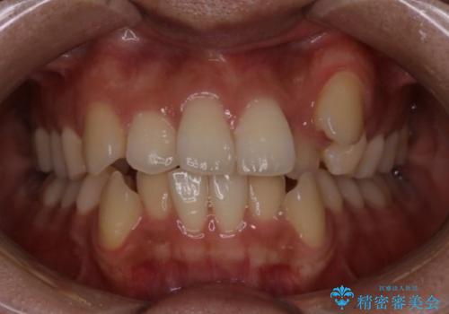 【クリア装置】八重歯の矯正治療の症例 治療前