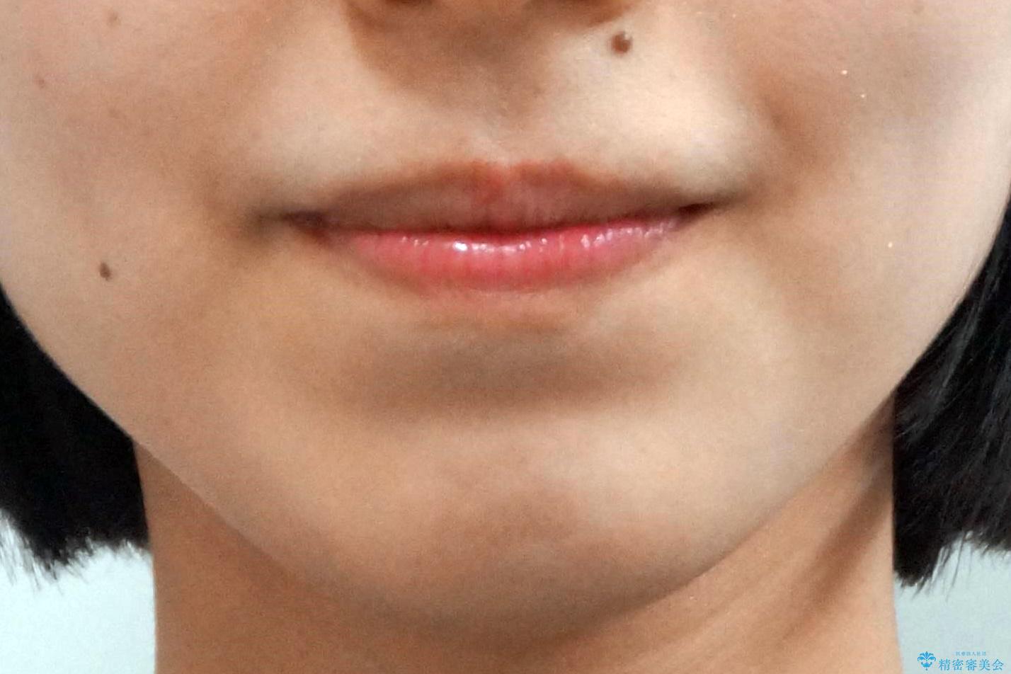 八重歯を非抜歯で マウスピースで治療 奥歯を後ろに下げてすき間を確保の治療後(顔貌)