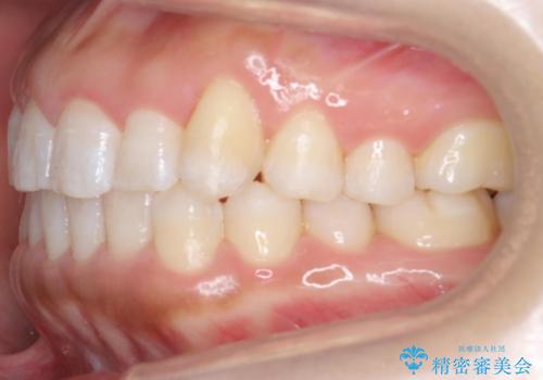 八重歯を非抜歯で マウスピースで治療 奥歯を後ろに下げてすき間を確保の治療後