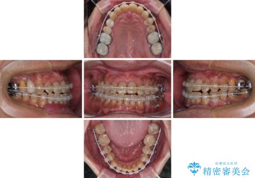 今からでも綺麗な歯並びを手に入れたい 40代男性のワイヤー矯正の治療中