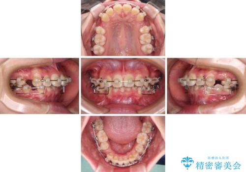 飛び出した上顎前歯 ワイヤー装置にて抜歯矯正治療の治療中
