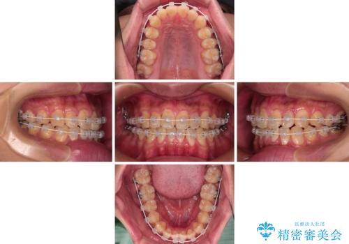 クロスバイトを楽して治す ワイヤー装置にて矯正治療の治療中