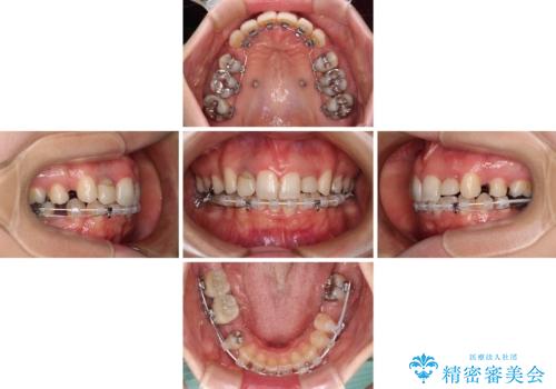 飛び出した上顎前歯とむし歯の多い歯列 目立たないハーフリンガル矯正とむし歯治療の治療中