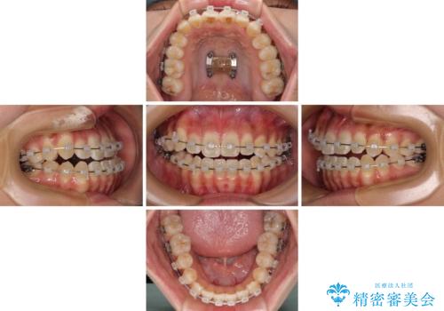 八重歯とオープンバイト 急速拡大装置を用いた矯正治療の治療中