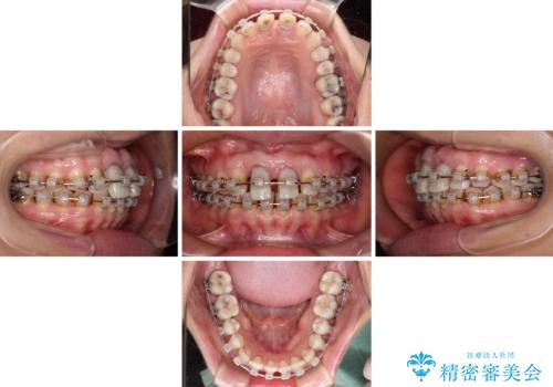 隙間をセラミックで閉じたら不格好で歯肉から出血 矯正治療と歯周外科で綺麗な前歯にの治療中