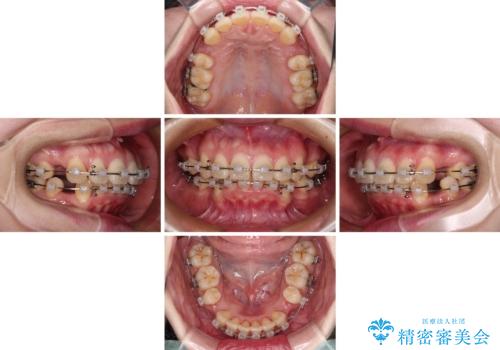 飛び出した上顎前歯 抜歯矯正でスッキリとした横顔にの治療中