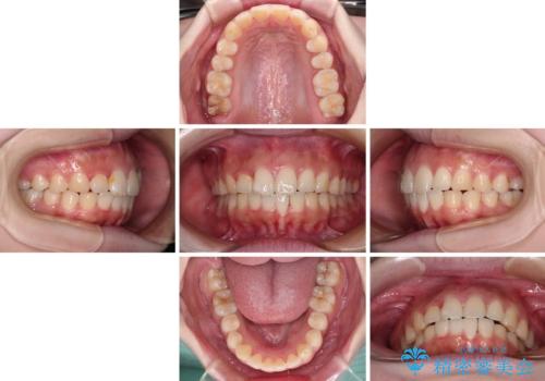 前歯のデコボコをインビザラインできれいに整えるの治療中