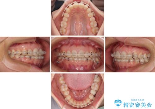 前歯を綺麗にしたい 部分矯正とセラミック治療の治療中