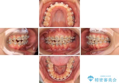 後戻りの再矯正 ワイヤー装置でデコボコと隙間を改善の治療中