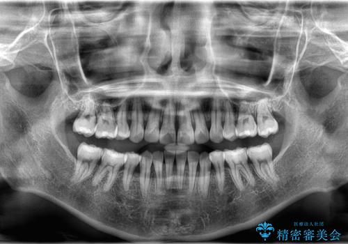【インビザライン】抜歯矯正で口元も改善の治療後