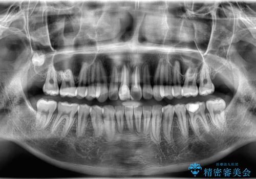【ワイヤー矯正 11ヵ月で矯正終了!】歯のでこぼこを治したい! の治療後