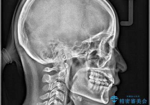 【インビザライン、10ヵ月で矯正終了!】下の前歯が斜めになっているのを治したい!の治療前