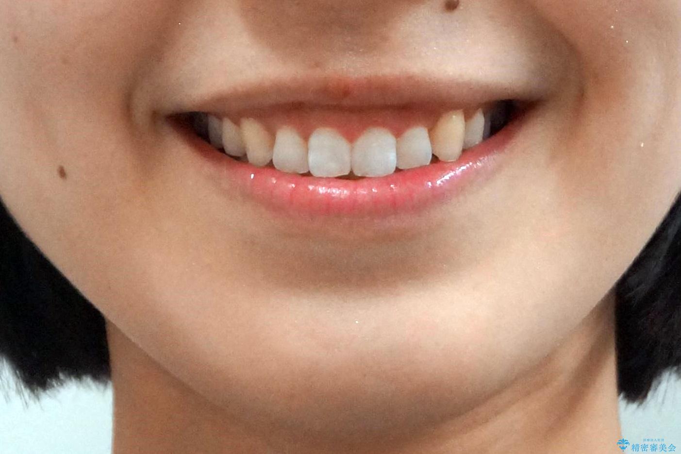 八重歯を非抜歯で マウスピースで治療 奥歯を後ろに下げてすき間を確保の治療後(顔貌)
