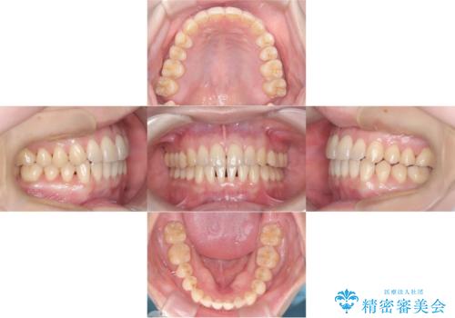 【インビザライン、10ヵ月で矯正終了!】下の前歯が斜めになっているのを治したい!の治療後