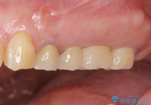 奥歯がない　咬合力を回復するインプラント治療の治療後