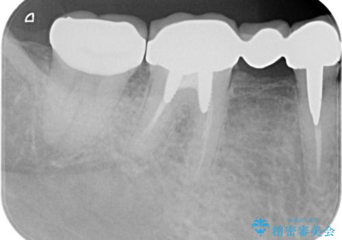 割れたセラミック下に再発した虫歯の治療後