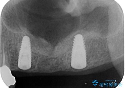 奥歯がない　咬合力を回復するインプラント治療の治療中