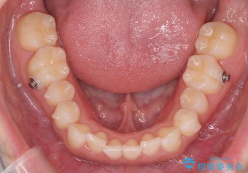 八重歯を非抜歯で　マウスピースで治療　奥歯を後ろに下げてすき間を確保の治療中
