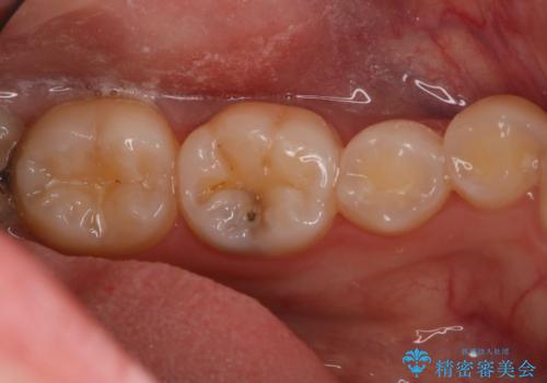 虫歯部分を白い詰め物で治したいの症例 治療前