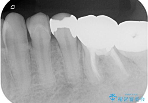 【セラミックインレー】銀の詰め物を白くしていきたいの治療前