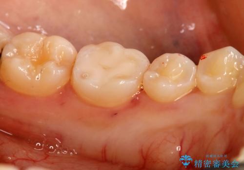 虫歯部分を白い詰め物で治したいの治療後