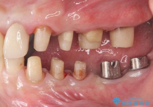 銀歯を外し、インプラントを入れたいの治療中