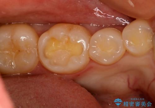 虫歯部分を白い詰め物で治したいの治療中
