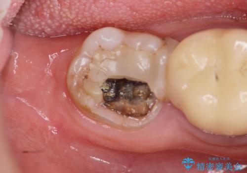 割れたセラミック下に再発した虫歯
