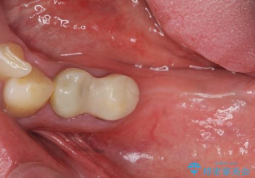 銀歯を外し、インプラントを入れたいの治療前