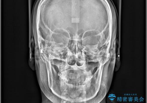 【インビザライン、10ヵ月で矯正終了!】下の前歯が斜めになっているのを治したい!の治療後