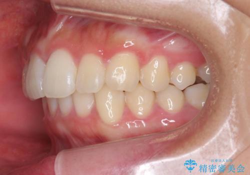 [ ワイヤー小矯正+マウスピース矯正 ]  前歯のねじれを短期間で治したいの治療後