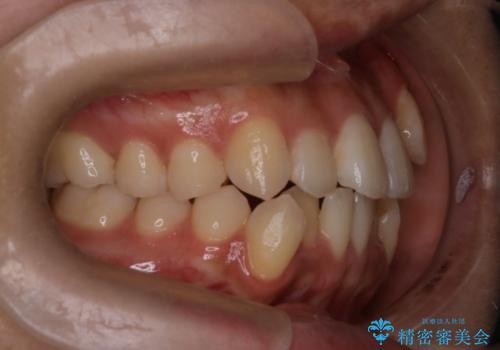 【クリア装置】八重歯の矯正治療の治療前