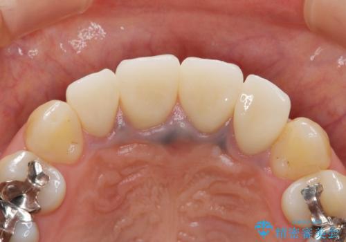 黒っぽい歯ぐきを改善したい　メタルフリーセラミック治療の治療後