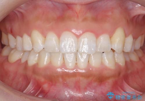 八重歯を非抜歯で　マウスピースで治療　奥歯を後ろに下げてすき間を確保の症例 治療後