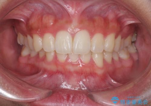 [ ワイヤー小矯正+マウスピース矯正 ]  前歯のねじれを短期間で治したいの症例 治療後