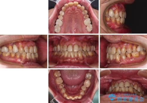 今からでも綺麗な歯並びを手に入れたい 40代男性のワイヤー矯正の治療前