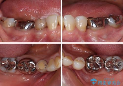 奥歯の目立つ銀歯をセラミックに オールセラミッククラウン治療の治療前