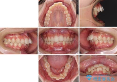 飛び出した上顎前歯 ワイヤー装置にて抜歯矯正治療の治療前