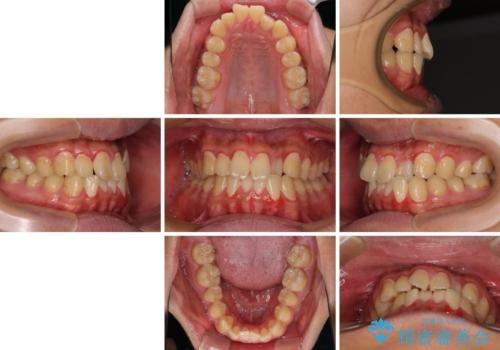 クロスバイトを楽して治す ワイヤー装置にて矯正治療の治療前