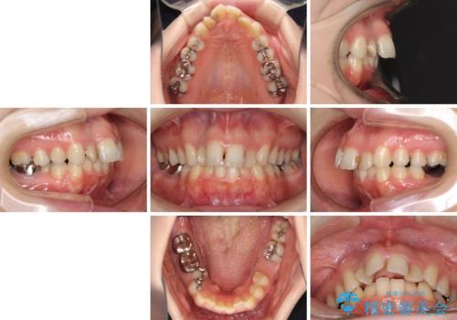 飛び出した上顎前歯とむし歯の多い歯列 目立たないハーフリンガル矯正とむし歯治療の治療前