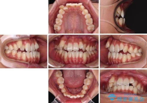 八重歯とオープンバイト　急速拡大装置を用いた矯正治療の治療前