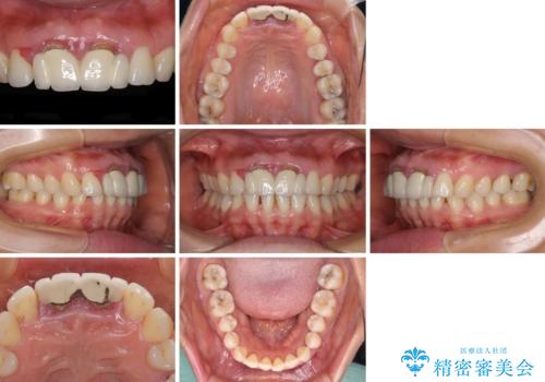 隙間をセラミックで閉じたら不格好で歯肉から出血 矯正治療と歯周外科で綺麗な前歯にの治療前