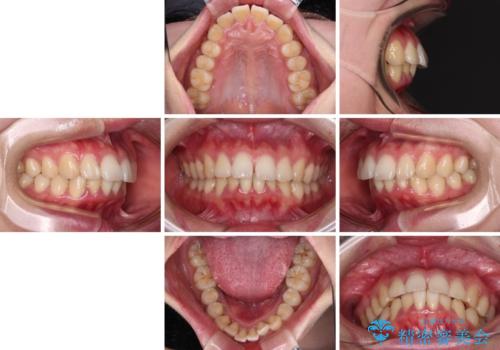飛び出した上顎前歯 抜歯矯正でスッキリとした横顔にの治療前