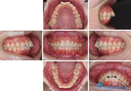 前歯のデコボコをインビザラインできれいに整えるの治療前