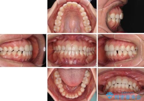 前歯を綺麗にしたい　部分矯正とセラミック治療の治療前